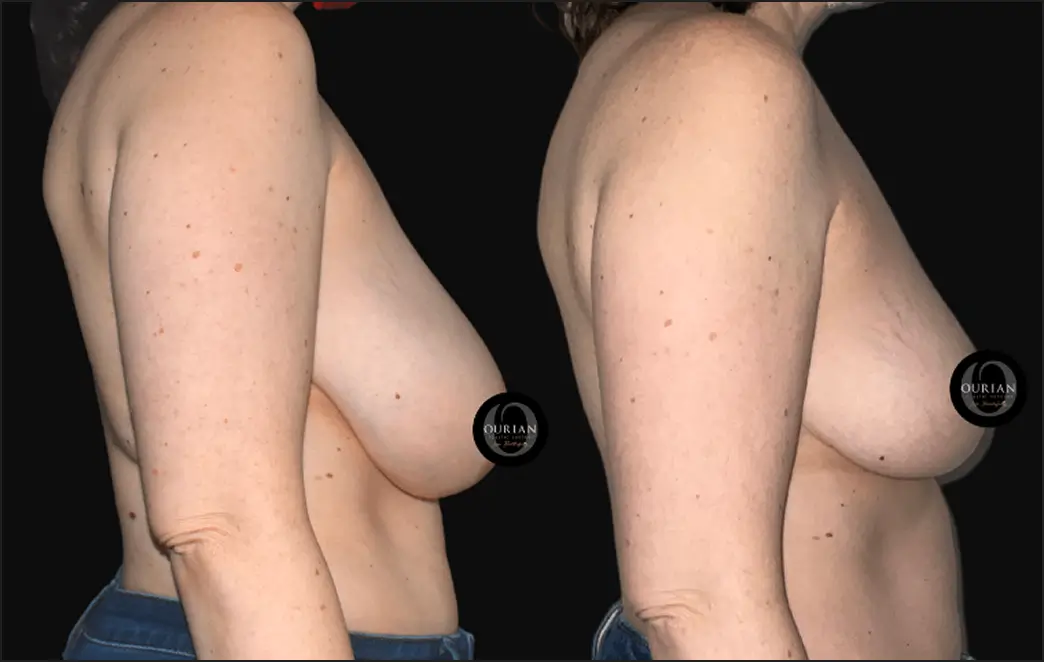 breast slider